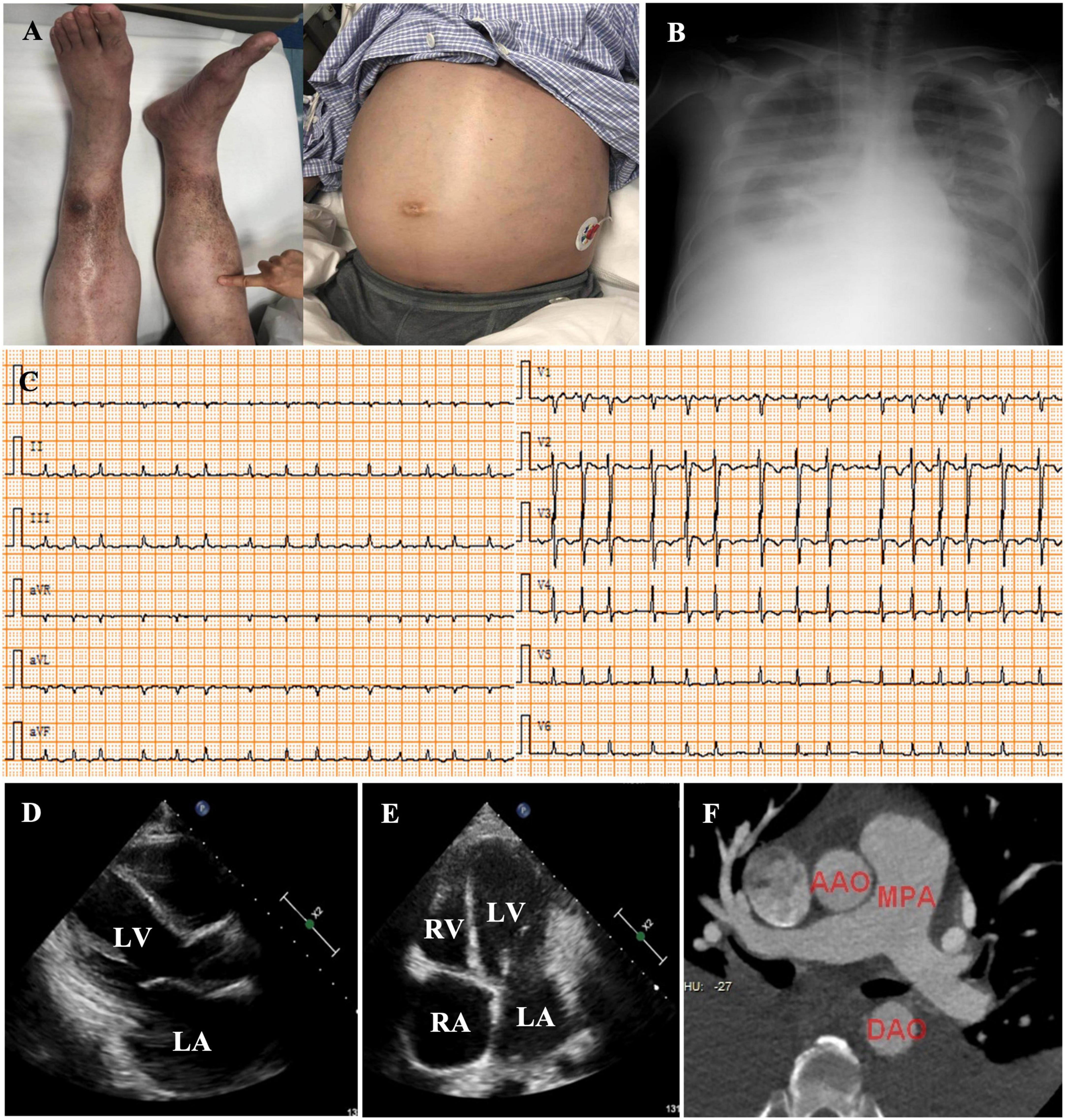 Case report: Mechanical-electric feedback and atrial fibrillation–Revelation from the treatment of a rare atrial fibrillation caused by annular constrictive pericarditis